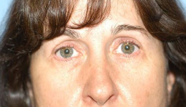 Eyelid Lift Before & After Gallery - Patient 6389476 - Image 2