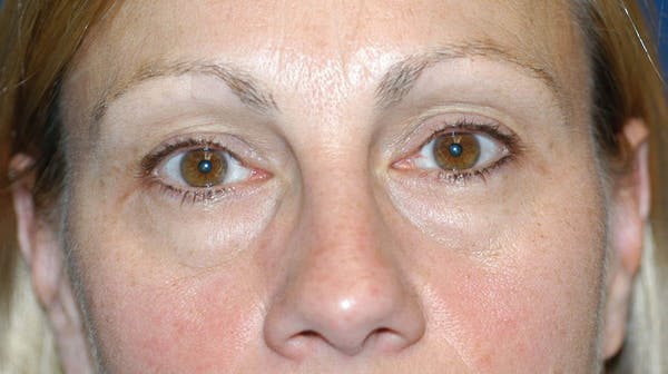 Eyelid Lift Before & After Gallery - Patient 6389466 - Image 1