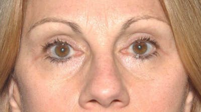 Eyelid Lift Before & After Gallery - Patient 6389466 - Image 2