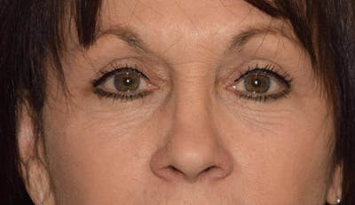 Eyelid Lift Before & After Gallery - Patient 6389463 - Image 2