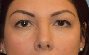 Before and After Blepharoplasty in Long Island