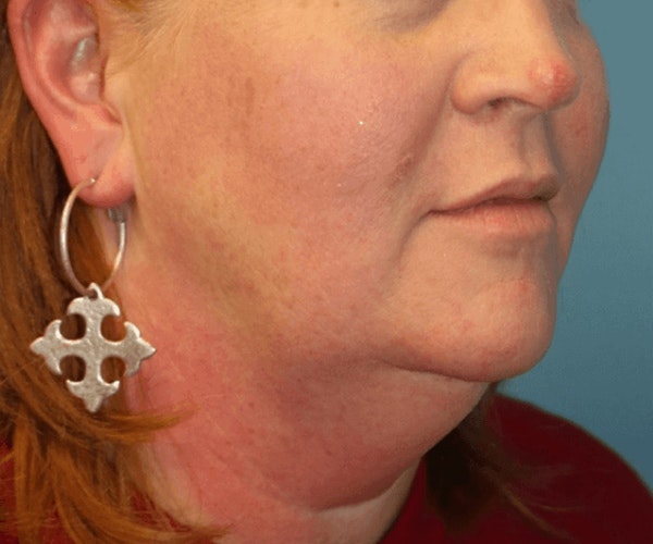 Neck Lift Before & After Gallery - Patient 6389449 - Image 5