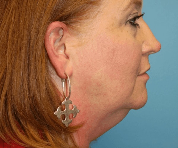 Neck Lift Before & After Gallery - Patient 6389449 - Image 1