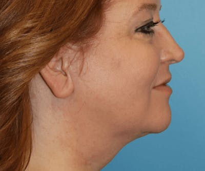 Neck Lift Before & After Gallery - Patient 6389449 - Image 2