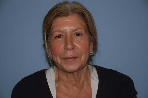 Neck Lift