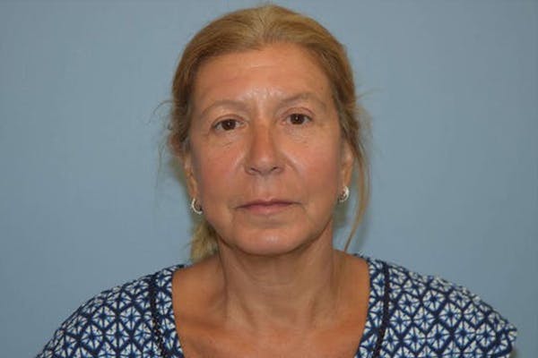 Neck Lift