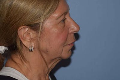 Neck Lift Before & After Gallery - Patient 6389453 - Image 1