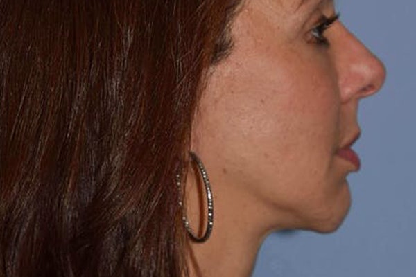 Chin Augmentation Before & After Gallery - Patient 6389457 - Image 2