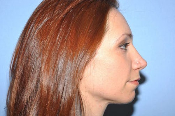 Chin Augmentation Before & After Gallery - Patient 6389461 - Image 1