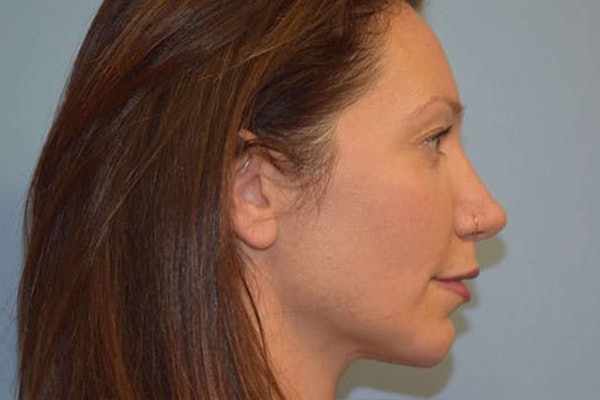 Chin Augmentation Before & After Gallery - Patient 6389461 - Image 2