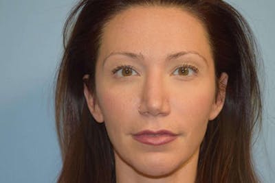 Chin Augmentation Before & After Gallery - Patient 6389461 - Image 4
