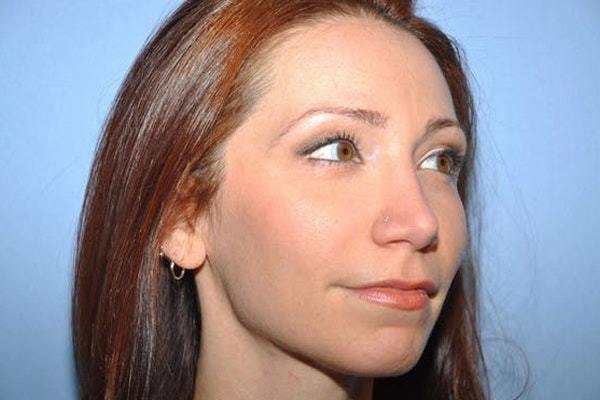 Chin Augmentation Before & After Gallery - Patient 6389461 - Image 5