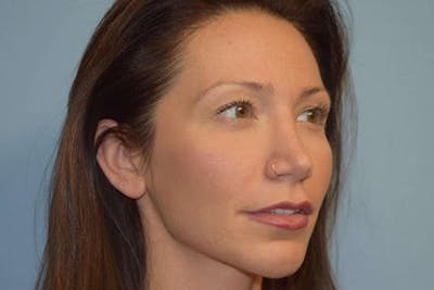 Chin Augmentation Before & After Gallery - Patient 6389461 - Image 6