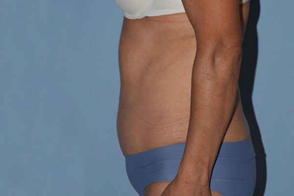 Tummy Tuck Before & After Gallery - Patient 14281235 - Image 6
