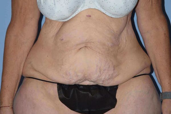 Tummy Tuck Before & After Gallery - Patient 14281279 - Image 1