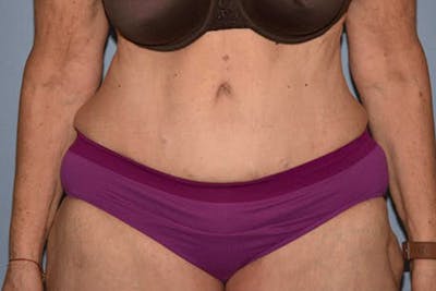 Tummy Tuck Gallery - Patient 14281279 - Image 2