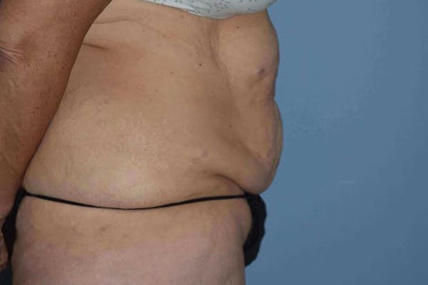 Tummy Tuck Before & After Gallery - Patient 14281279 - Image 7