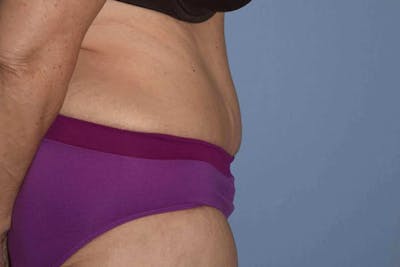 Tummy Tuck Before & After Gallery - Patient 14281279 - Image 8
