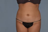 Liposuction Before & After Gallery - Patient 14281451 - Image 1