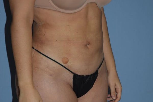 Liposuction Gallery - Patient 14281451 - Image 4