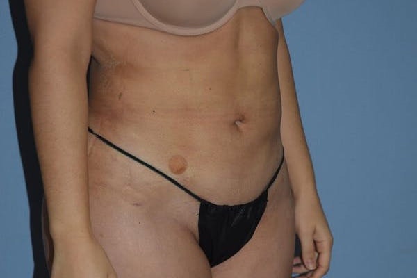 Liposuction Before & After Gallery - Patient 14281451 - Image 4