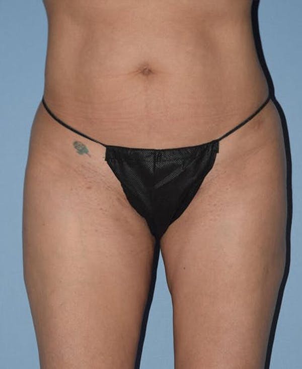 Liposuction Gallery - Patient 14281452 - Image 2