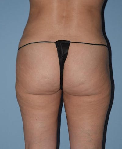Liposuction Before & After Gallery - Patient 14281452 - Image 4