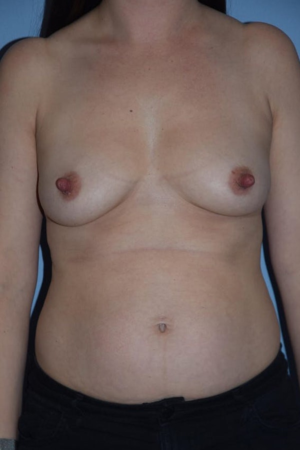 Mommy Makeover Before & After Gallery - Patient 14281462 - Image 1