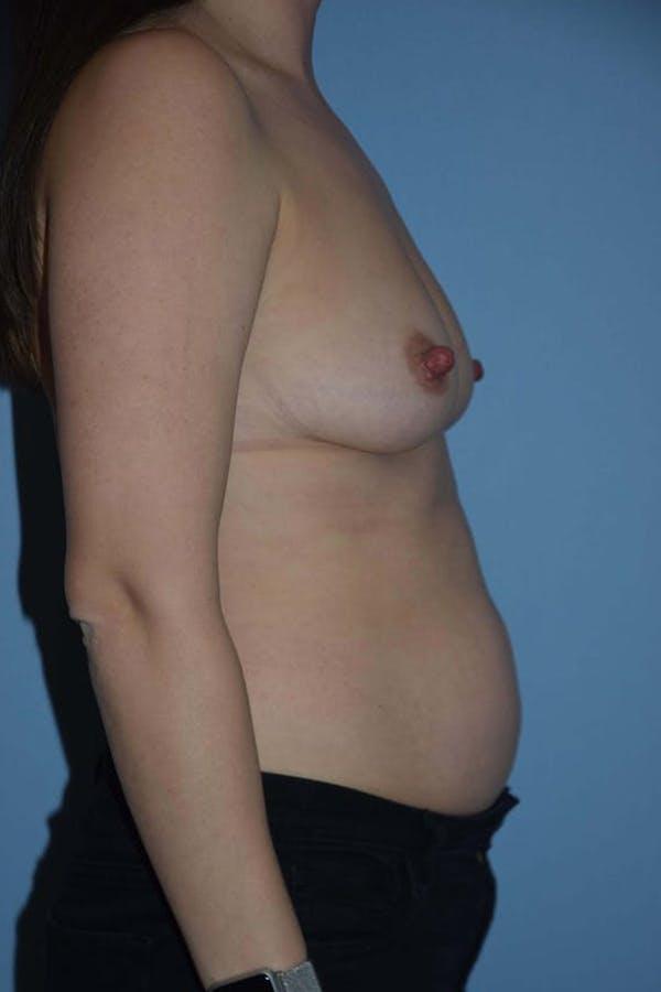 Mommy Makeover Gallery - Patient 14281462 - Image 3