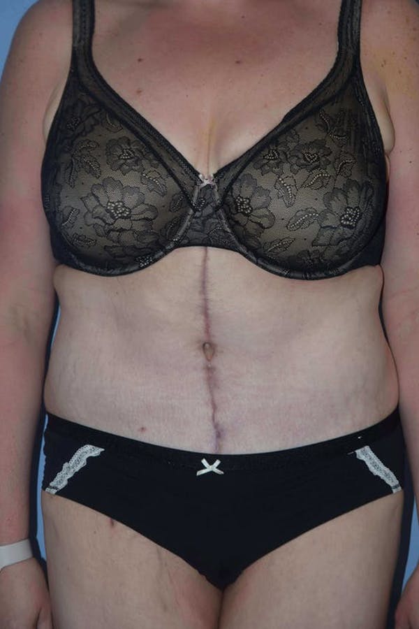 After Weight Loss Surgery Gallery - Patient 14281497 - Image 2