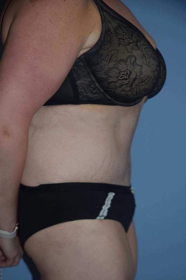 After Weight Loss Surgery Before & After Gallery - Patient 14281497 - Image 4