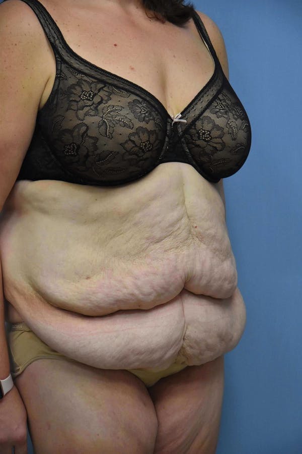 After Weight Loss Surgery Gallery - Patient 14281497 - Image 5