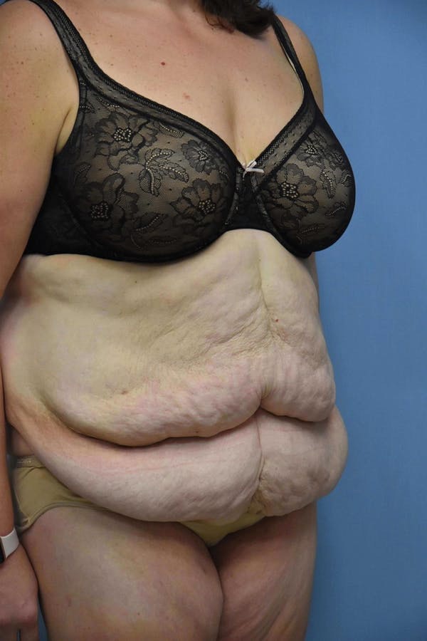 After Weight Loss Surgery Before & After Gallery - Patient 14281497 - Image 5