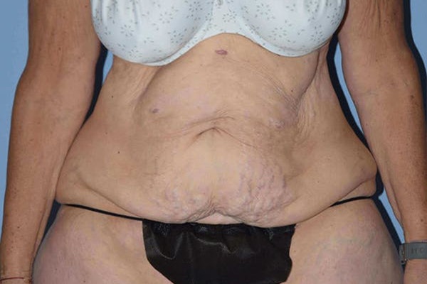 After Weight Loss Surgery Before & After Gallery - Patient 14281500 - Image 1