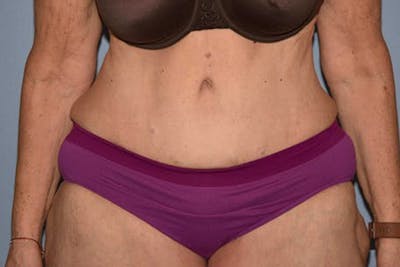 After Weight Loss Surgery Before & After Gallery - Patient 14281500 - Image 2