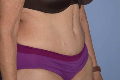 After Weight Loss Surgery Before & After Gallery - Patient 14281500 - Image 4