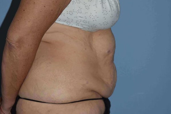 After Weight Loss Surgery Before & After Gallery - Patient 14281500 - Image 5