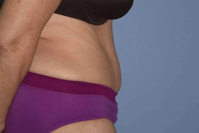 After Weight Loss Surgery Before & After Gallery - Patient 14281500 - Image 6