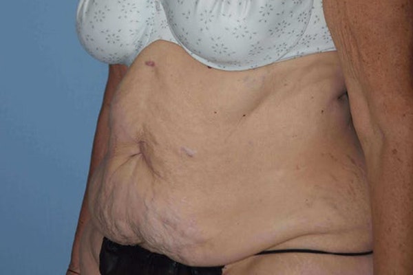 After Weight Loss Surgery Before & After Gallery - Patient 14281500 - Image 7