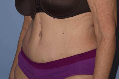 After Weight Loss Surgery Gallery - Patient 14281500 - Image 8