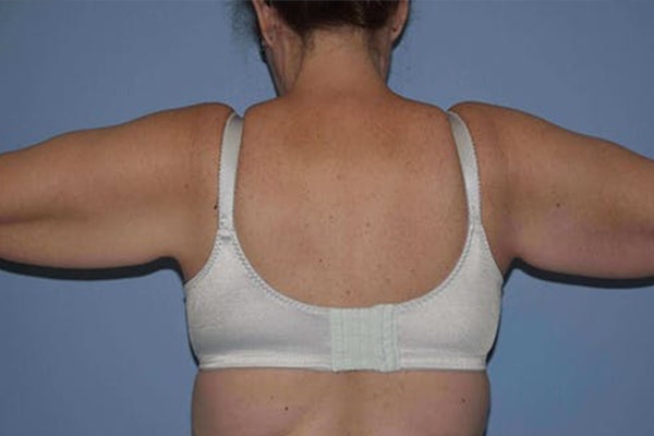 Arm Lift Before & After Gallery - Patient 14281507 - Image 1