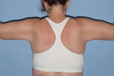 Arm Lift Before & After Gallery - Patient 14281507 - Image 2