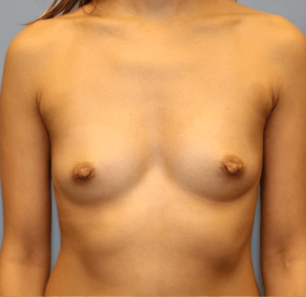 Breast Augmentation Gallery - Patient 14281567 - Image 1
