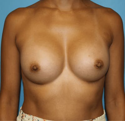 Breast Augmentation Before & After Gallery - Patient 14281567 - Image 2