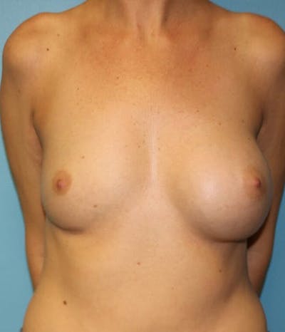 Breast Revision Before & After Gallery - Patient 14281712 - Image 1