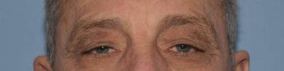 Eyelid Lift Gallery - Patient 14281801 - Image 1