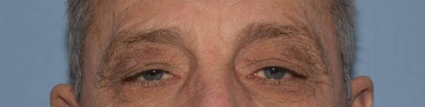 Eyelid Lift Before & After Gallery - Patient 14281801 - Image 1