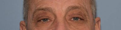 Eyelid Lift Before & After Gallery - Patient 14281801 - Image 2