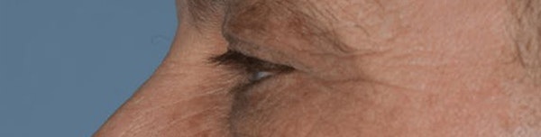 Eyelid Lift Before & After Gallery - Patient 14281801 - Image 3