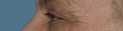 Eyelid Lift Before & After Gallery - Patient 14281801 - Image 4